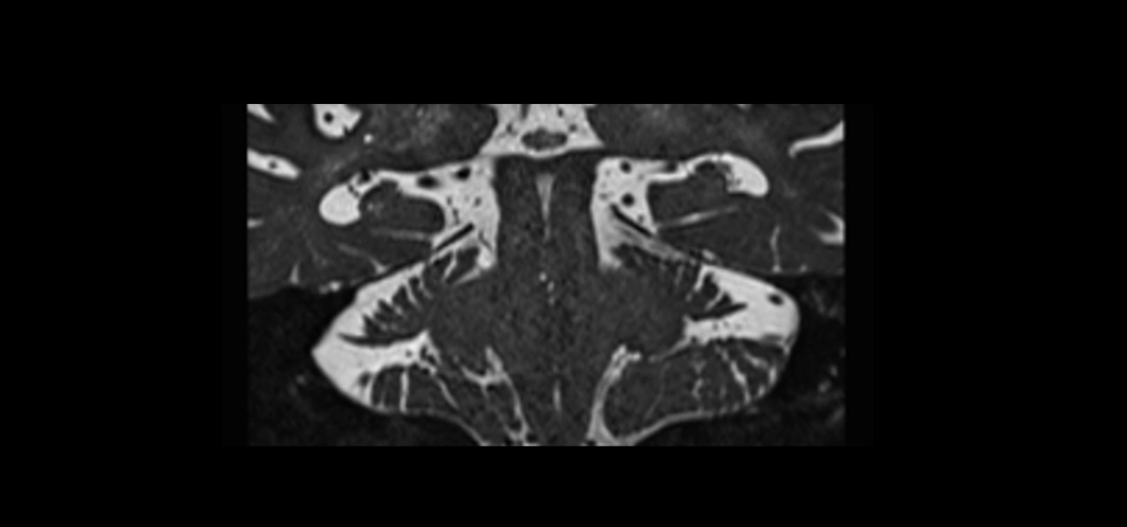 Cranial nerve cross sectional anatomy coronal 3T MRI image 50.webp